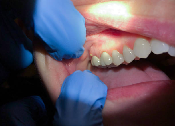Best Emergency Dentist for Lost Fillings or Crowns in Browns Point, WA